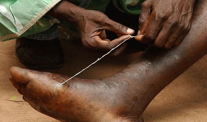 Extraction of subcutaneous parasites from the foot