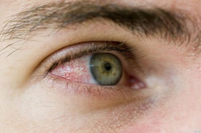 Eye problems due to parasites