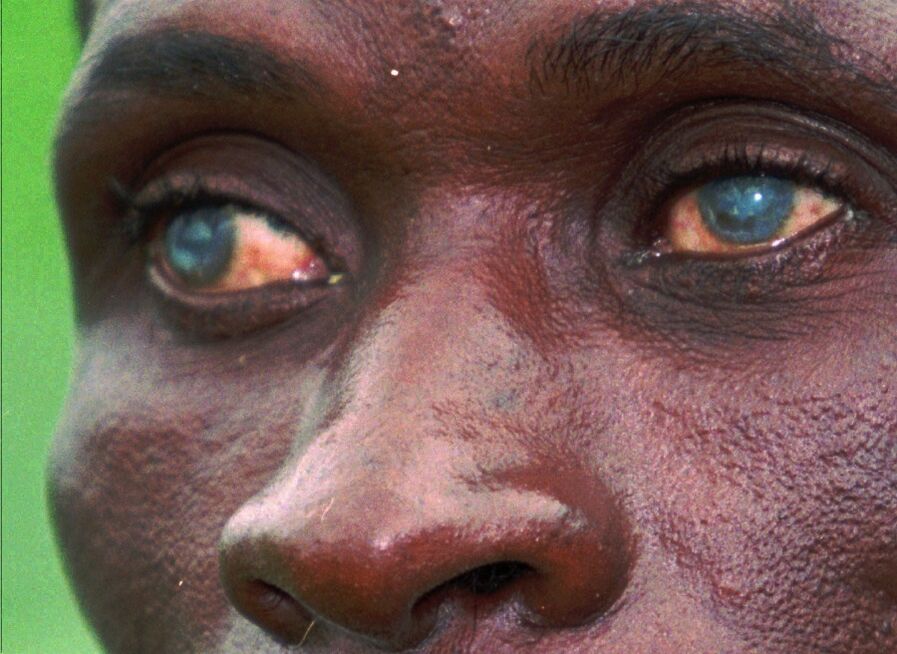Parasites in the human eye