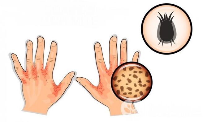 Scabies in humans caused by parasites