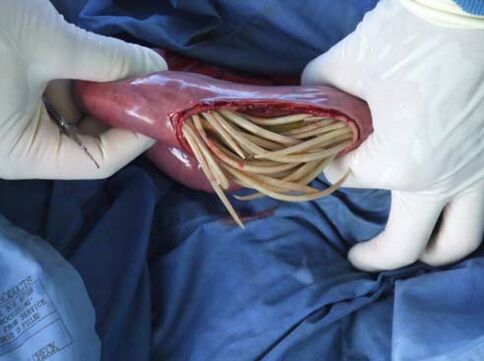 Parasites in the intestines